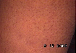 Evolução tratamento depilar 4